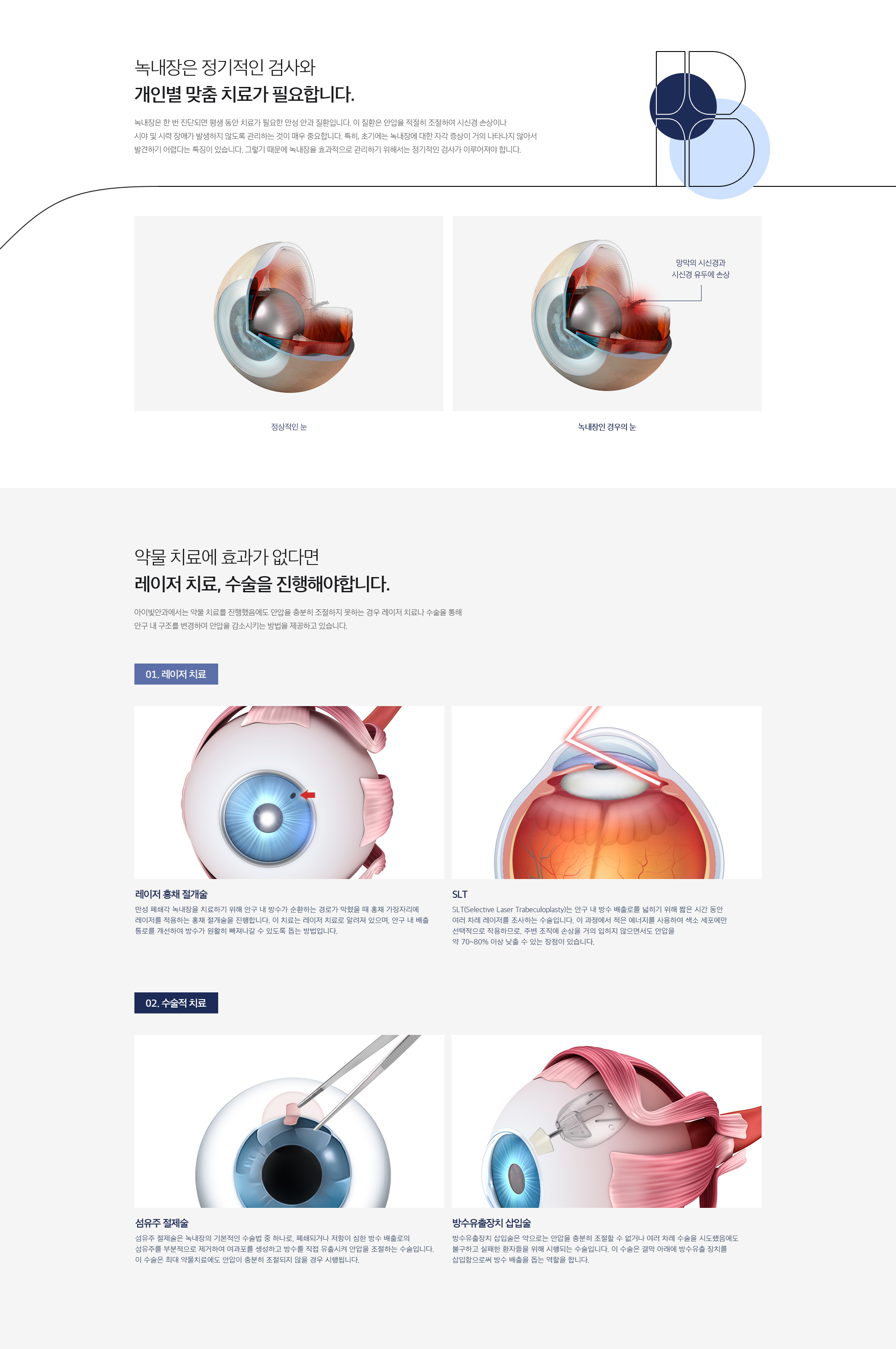 녹내장 레이저, 수술